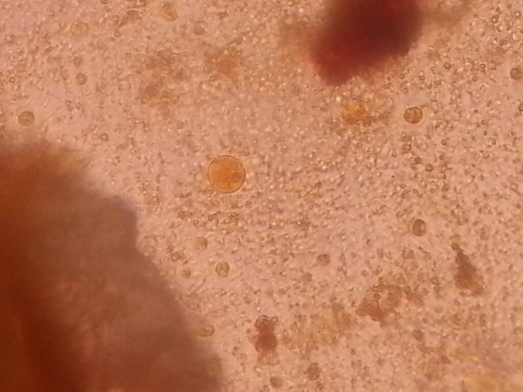 Entamoeba histolytica cyst in Iodine mount of feces microscopy