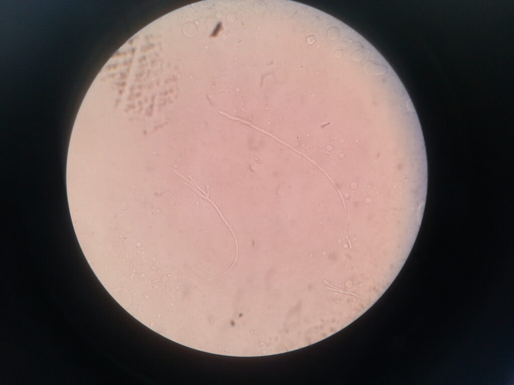 Fungal hyphae in KOH mount of ear discharge