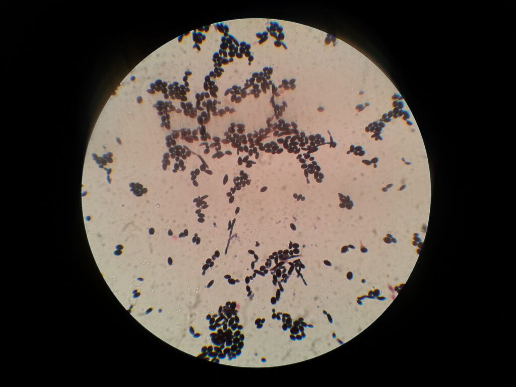 Gram positive yeast cells in Gram staining of culture