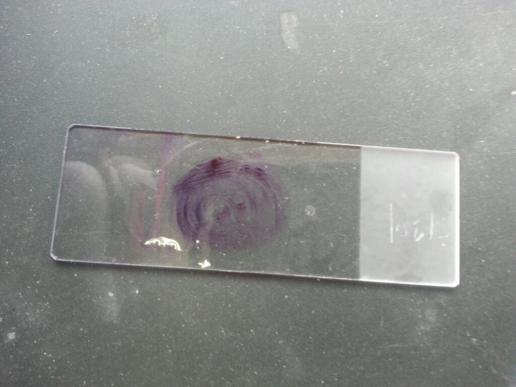 Gram stained smear of sputum