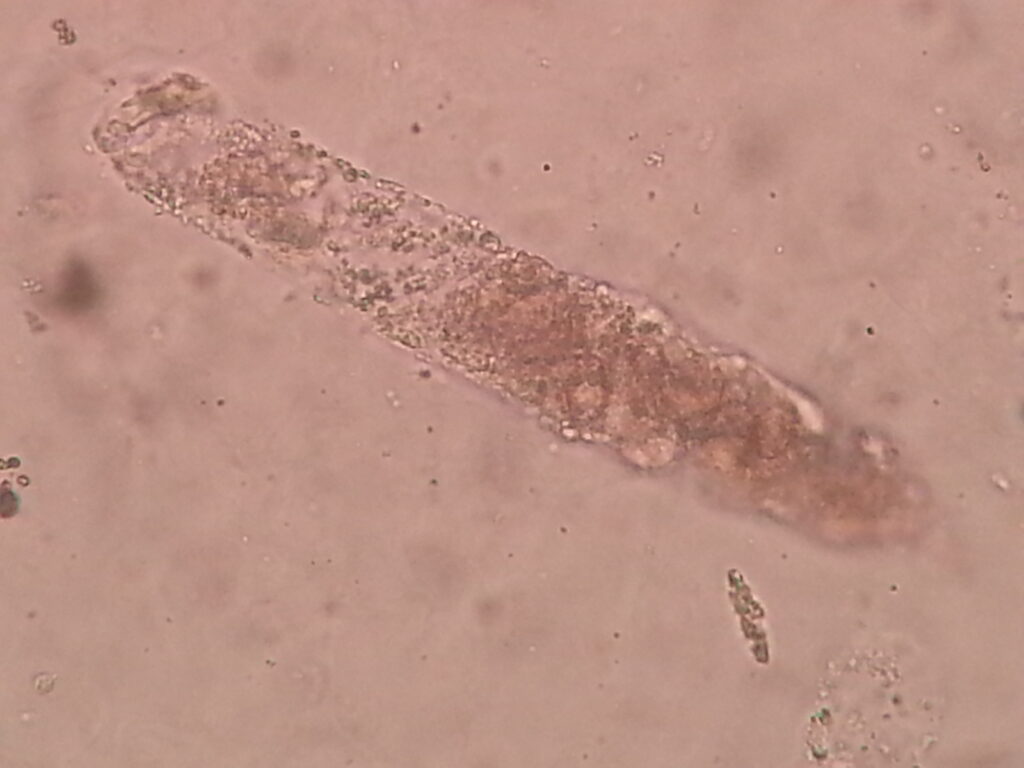 Granular Cast encountered during urine microscopy