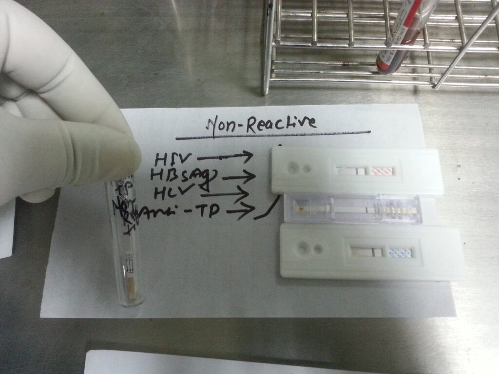 HIV, HBsAg,HCV and Treponema pallidum antibody rapid tests positive  demonstration