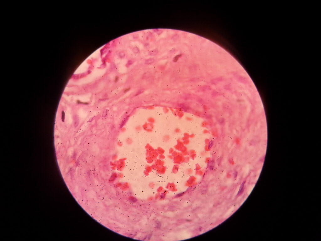 Haematoxylin and Eosin stained biopsy microscopy