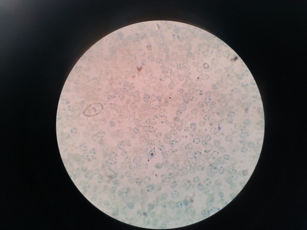 Haemoglobin H (HbH)inclusions or bodies in supravital stain(brilliant cresyl blue)