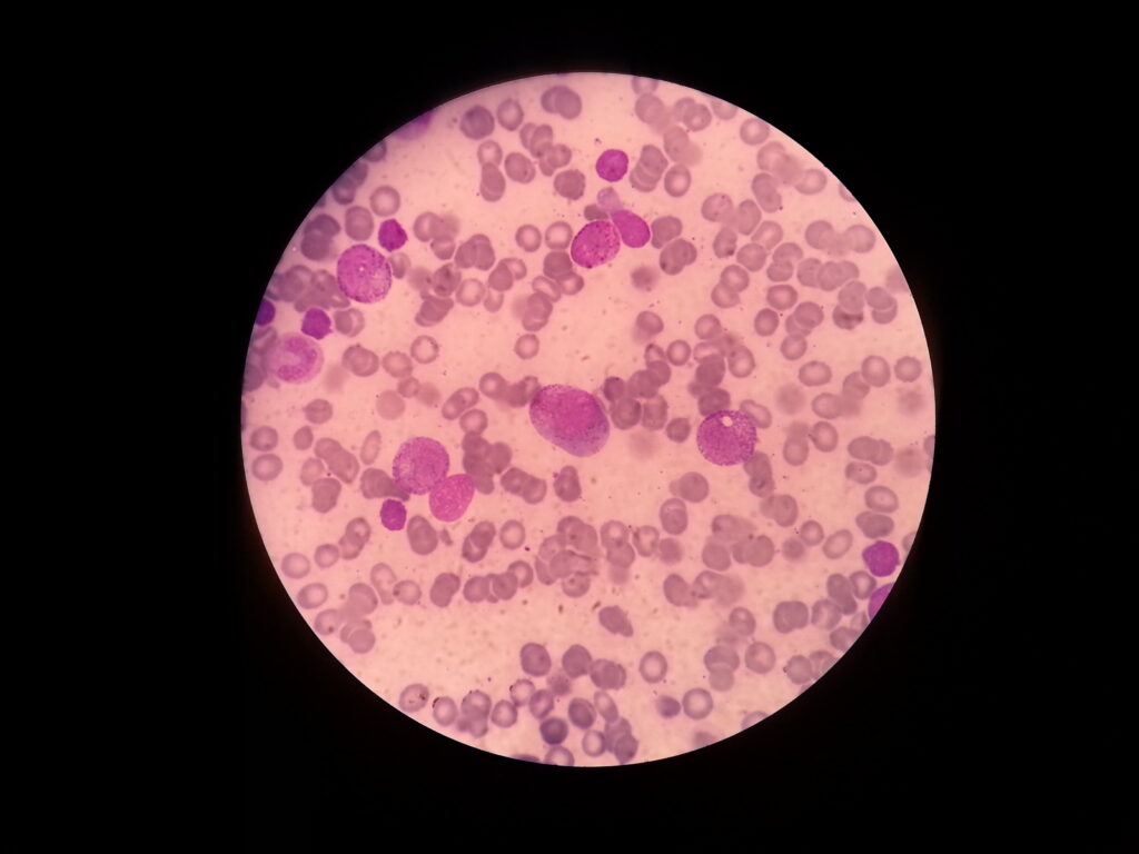 Histoblast with metachromatic granules in Wright stained smear of bone marrow
