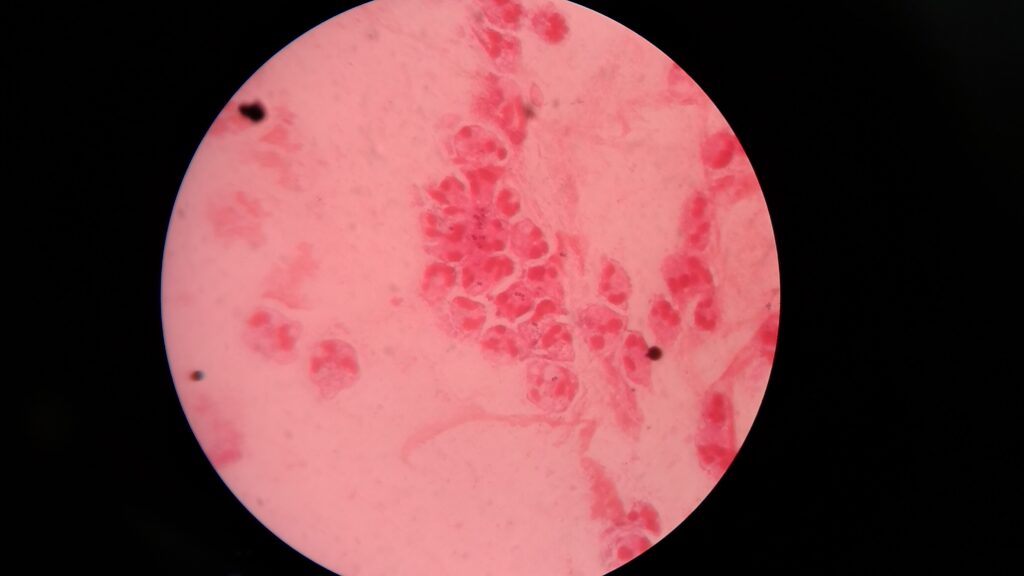 Plenty of pus cells in Gram stained smear of sputum
