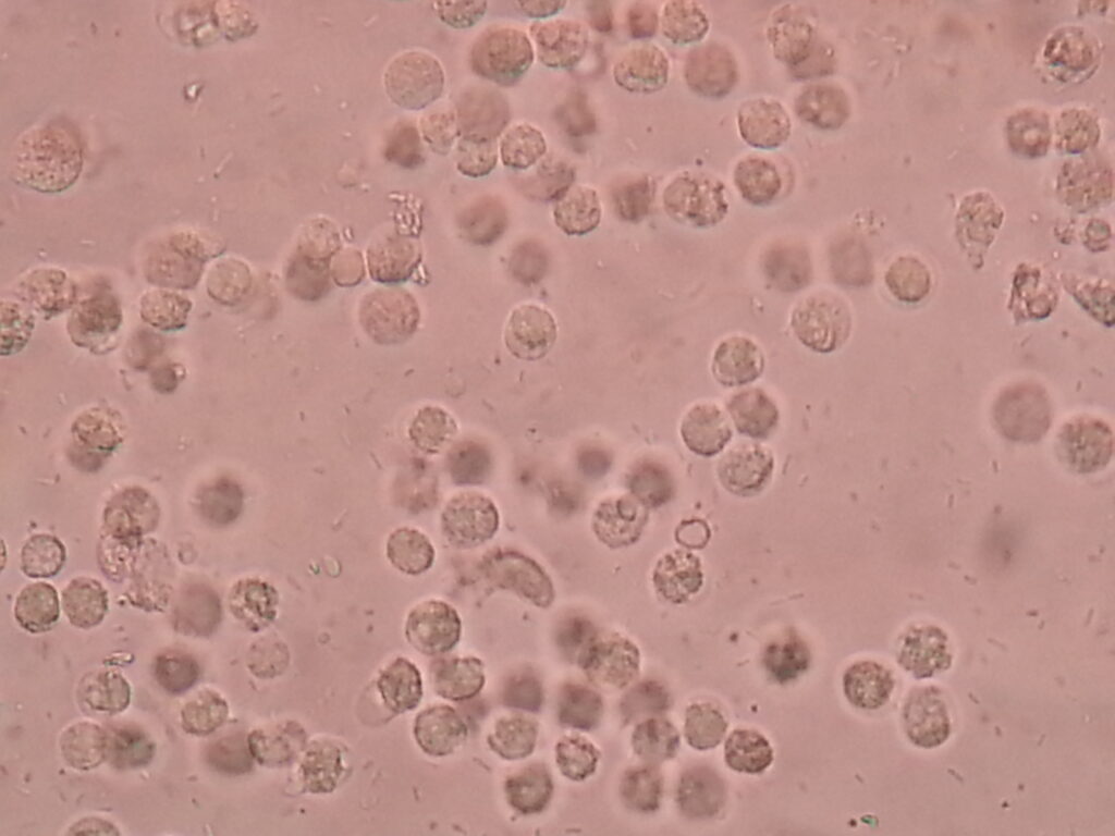 Pus cells in urine microscopy