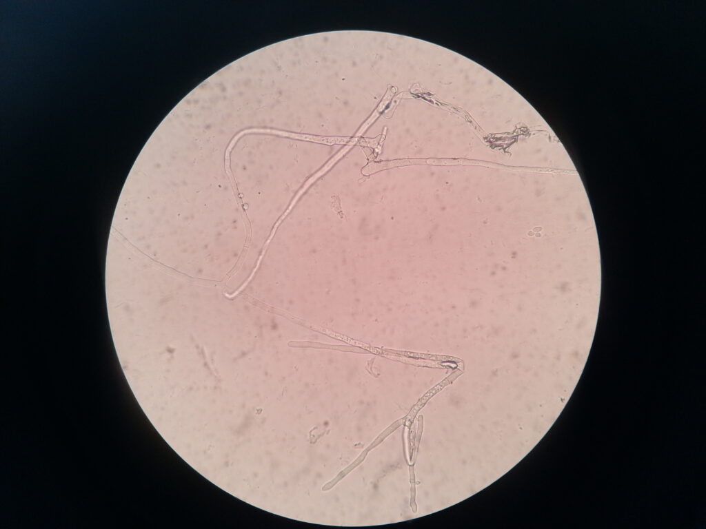 Septate dichotomous branching hyphae in KOH mount of ear pus