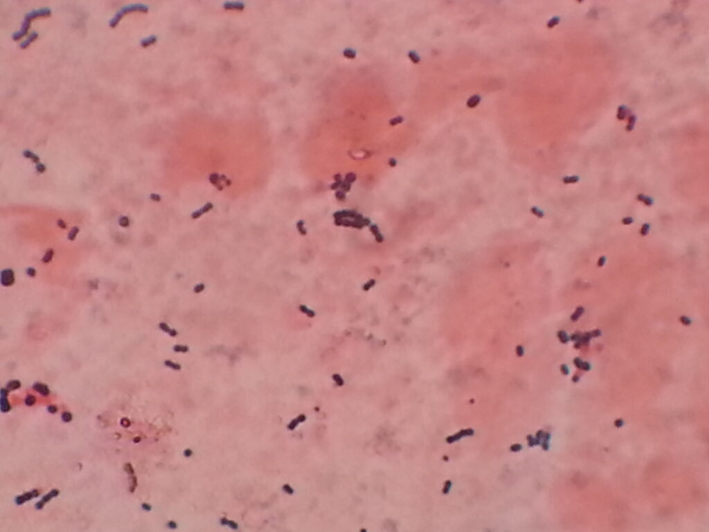 Streptococcus pyogenes in Gram staining showing Gram positive cocci in chains