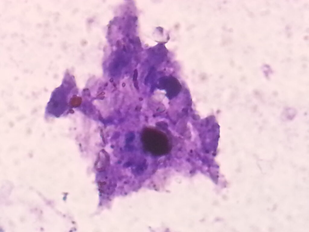 Tzanck smear positive picture of Giemsa stained smear of ulcer microscopy