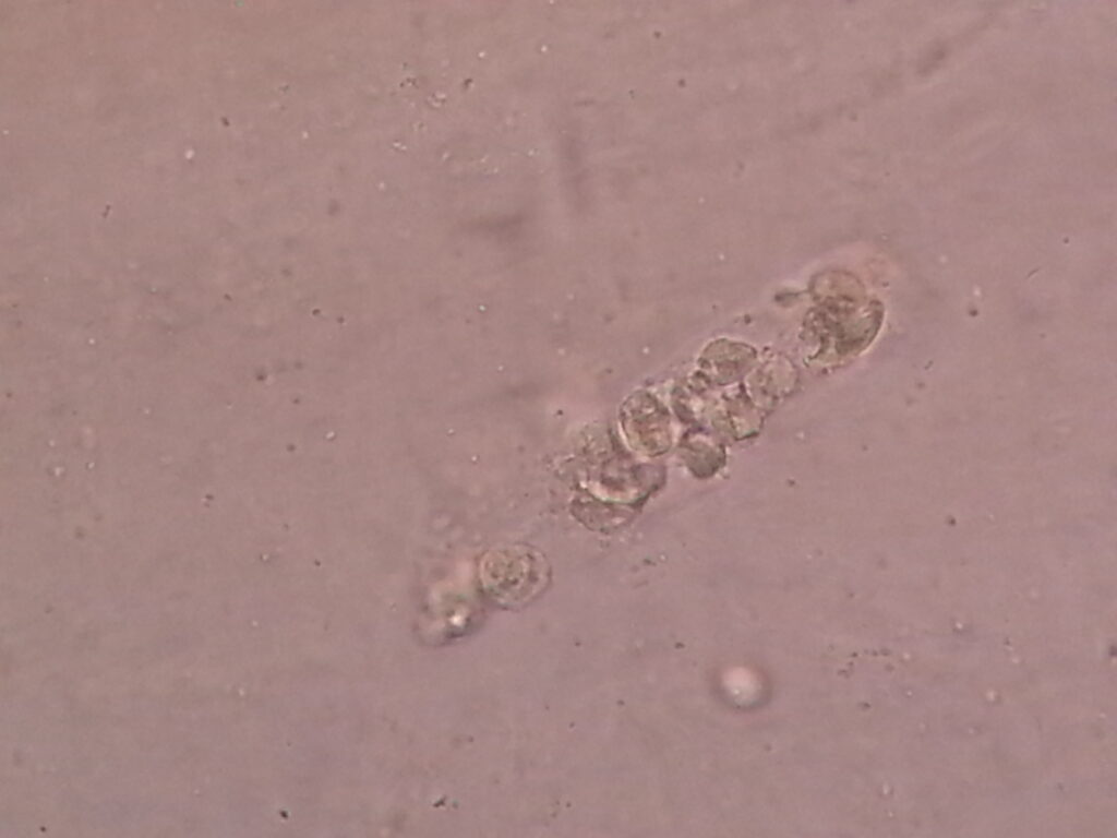 WBC cast in urine microscopy
