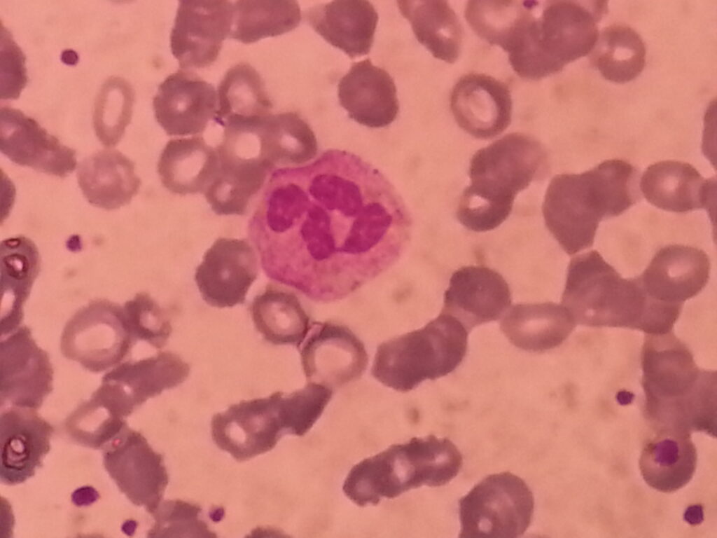 WBC (neutrophil) at centre, numerous erythrocytes and platelets (dot like bodies) in Wright's stained smear of peripheral blood(PBS) microscopy