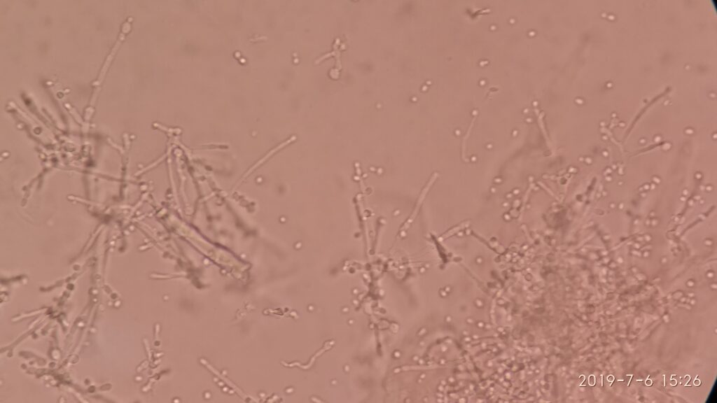 Yeast cells and fungal hyphae in KOH mount microscopy of sputum