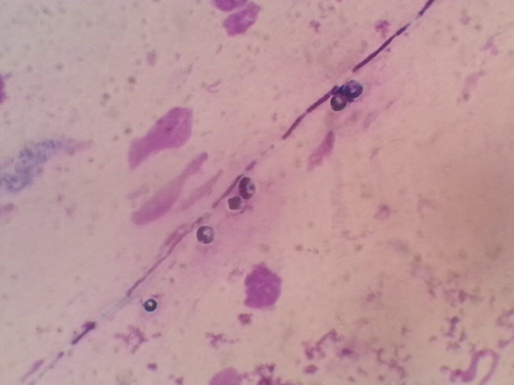 Yeast cells and hyphae in Giemsa staining
