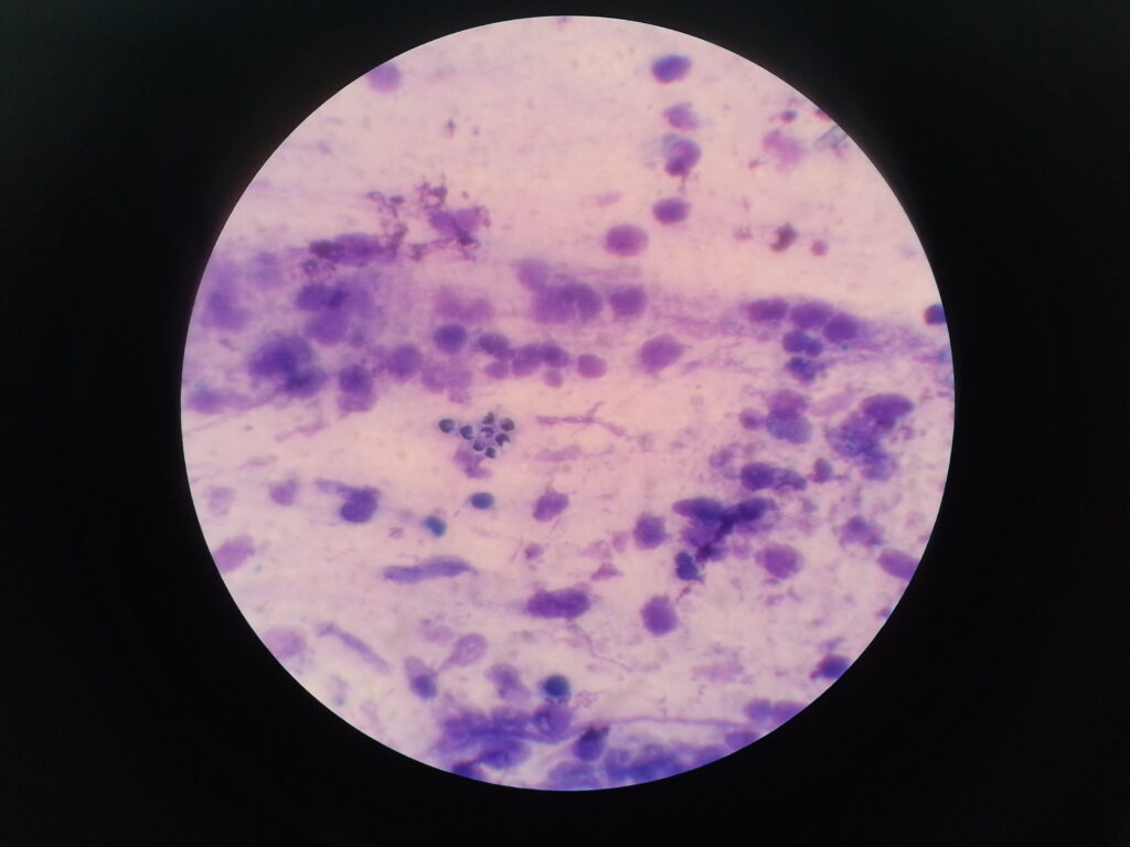 Yeast cells in Giemsa stained smear of sputum at oil immersion field