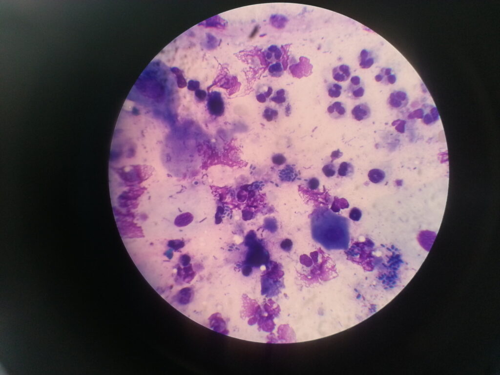 Yeast cells of Candida in Giemsa stained smear of sputum