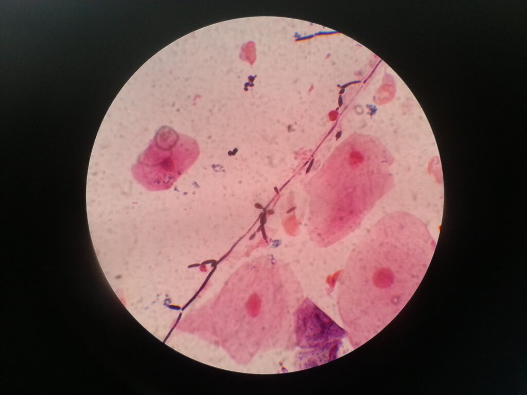 Yeast cells, pseudohyphae and epithelial cells in Gram stained smear of sputum microscopy at oil immersion field (OIF)