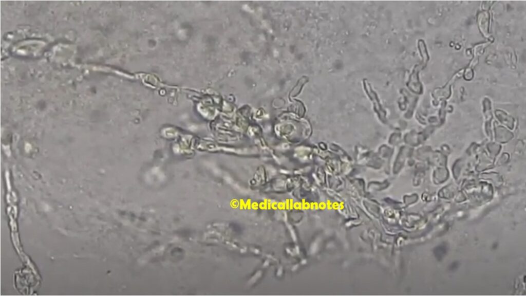 Fungal infected nail in KOH mount microscopy showing chlamydospores and fungal hyphae
