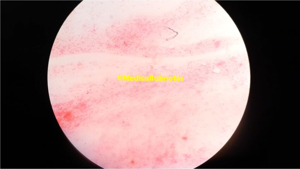 Ideal smear of sputum showing numerous pus cells and only few epithelial cells at a magnification of 100X