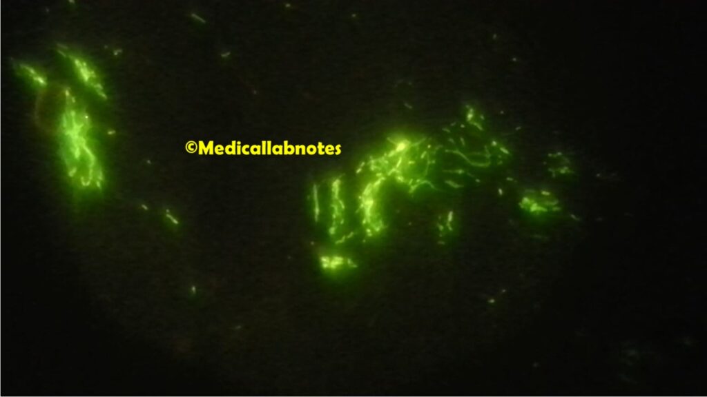 Nocardia in fluorochrome (Auramine o) stained smear of sputum microscopy