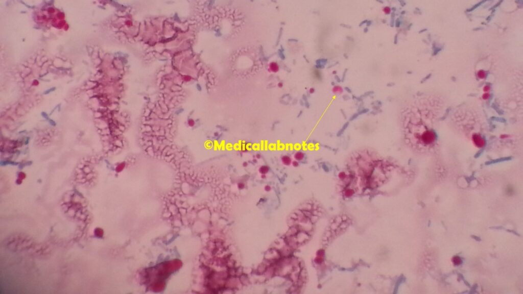 Oocyst of cryptosporidium parvum in Modified Kinyoun's acid-fast stain of stool microscopy