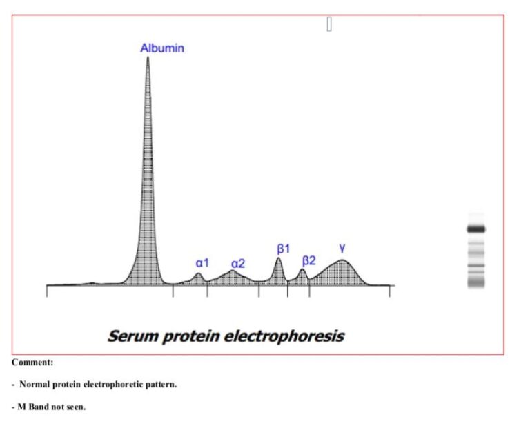 Serum Protein Electrophoresis Introduction Pattern Application Serum Protein Electrophoresis Introduction Pattern Application