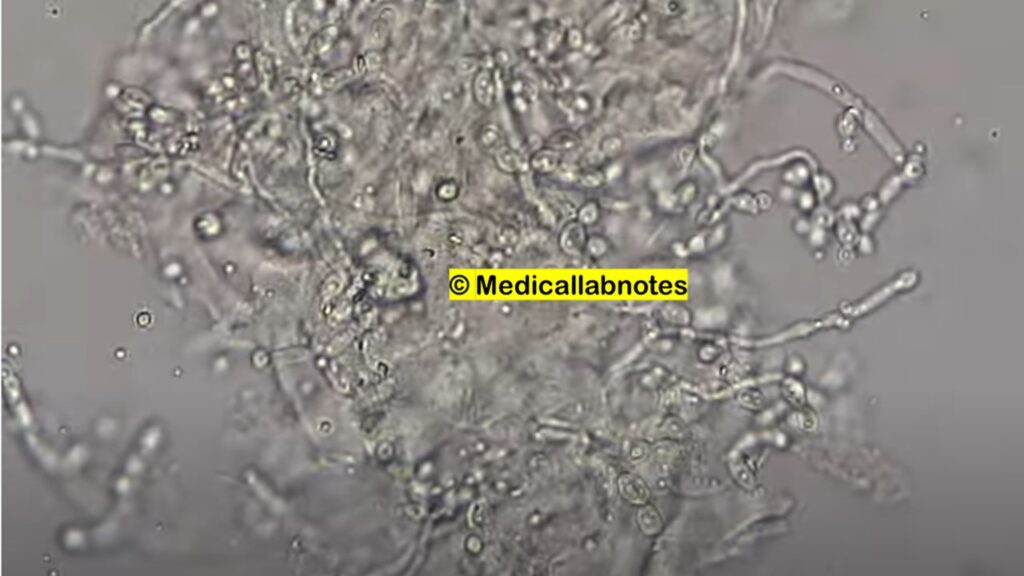 Candida yeast cells, yeast cells budding and pseudohyphae in potassium hydroxide (KOH) mount of Sputum microscopy