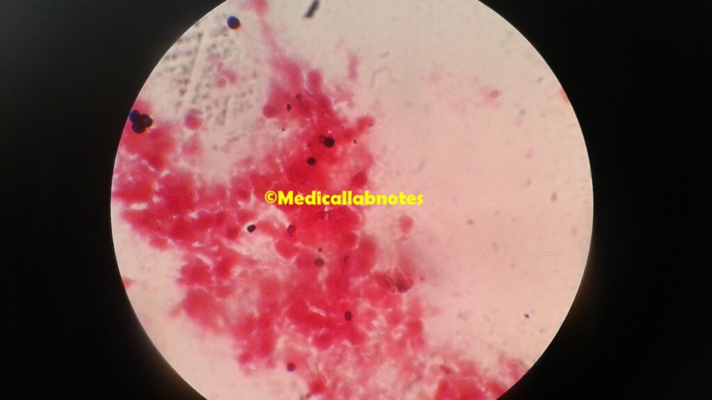 Conidia of Aspergillus in Gram staining of ear dischagre
