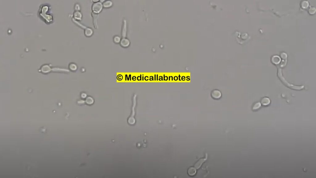 Germ Tube Test (GTT) -Positive  of Candida albicans