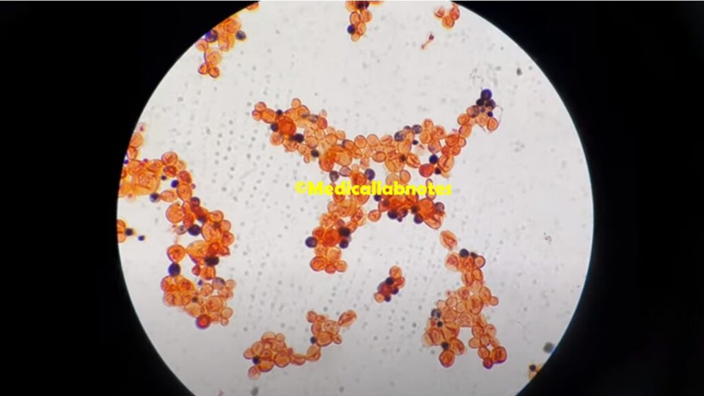 Live and dead yeast cells of Cryptococcus neoformans in Gram staining of old culture