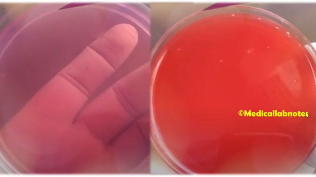 Pus cells in Urine lacking growth on Culture Media-MacConkey agar and Blood agar
