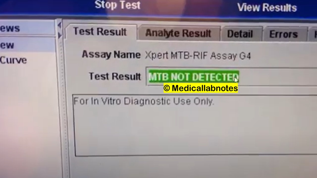 TB PCR for Sputum Introduction, Test Result, Unit, Normal Range