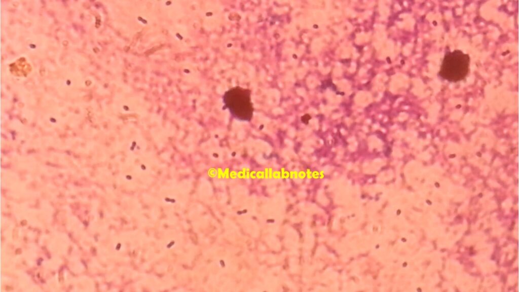 Encapsulated Streptococcus pneumoniae in Gram staining of CSF showing Gram positive diplococci
