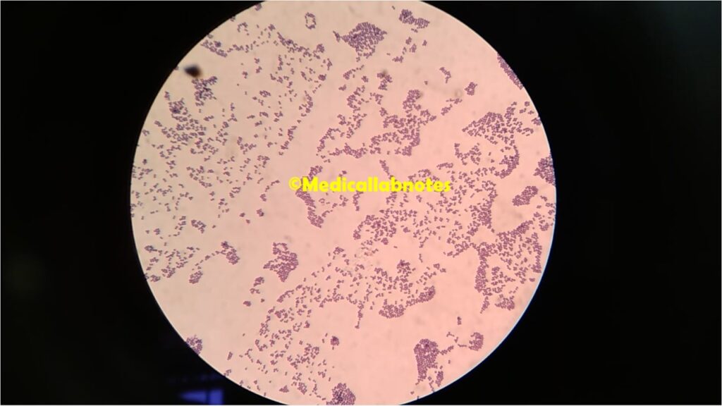 Gram positive cocci in singles, pairs, chains and clusters of Staphylococcus saprophyticus in Gram staining of culture microscopy at a magnification of 1000X