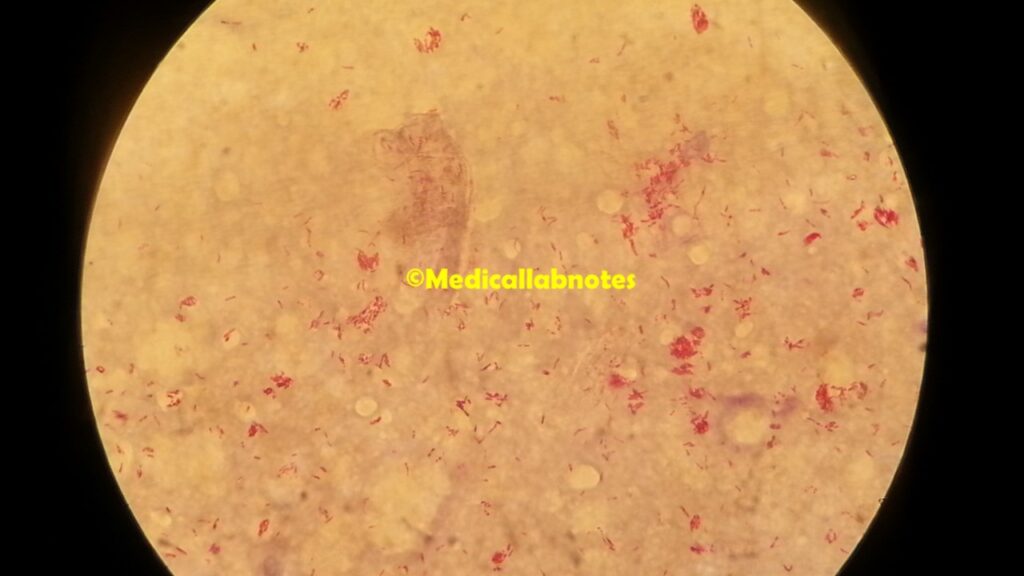 Heavy load of acid fast bacilli(AFB) of M. leprae in clumps and globi in modified Ziehl-Neelsen (Cold staining) of skin smear microscopy