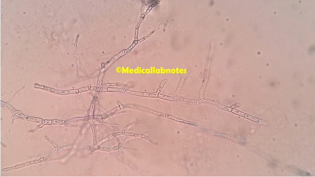 Microsporum ferrugineum in LPCB taese mount of culture microscopy showing typical bamboo hyphae and lacking production of both microconidia and macroconidia