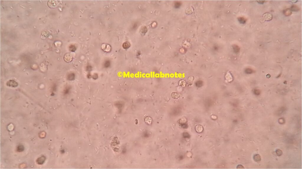 Urine of UTI patient showing pus cells and Escherichia coli bacteria