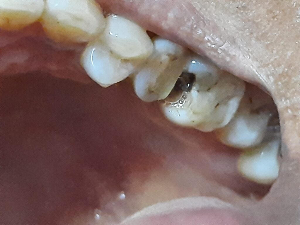 Close-up of a deep cavity on the chewing surface of an upper molar