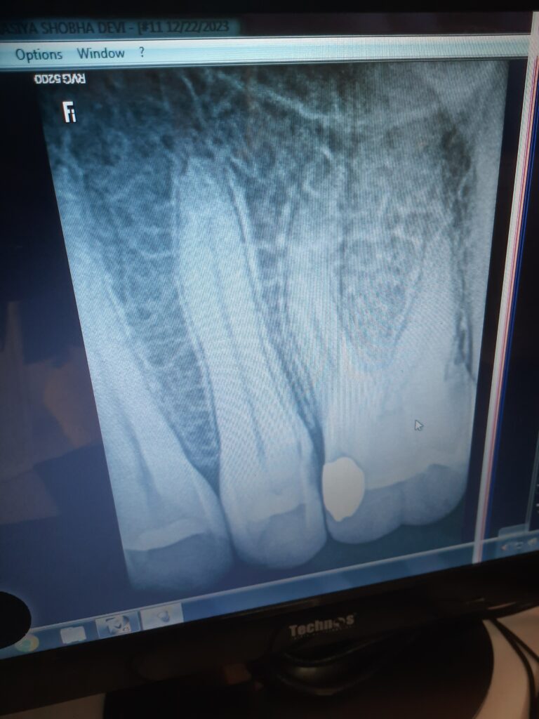 Dental Radiography (X-Ray)