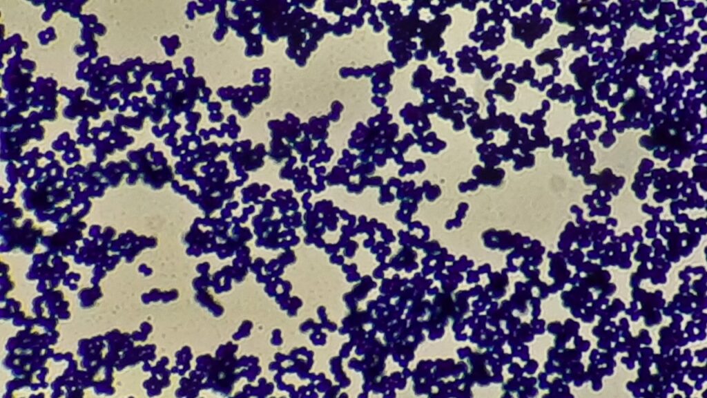 Gram positive cocci in singles, pairs and tetrads of Micrococcus in Gram staining of culture