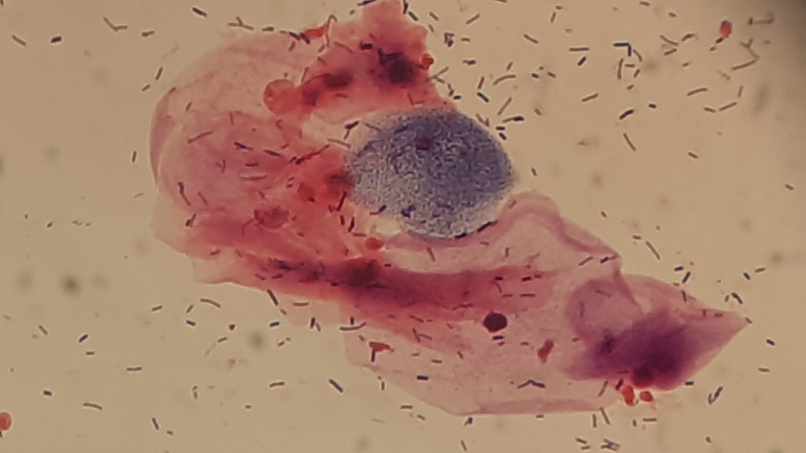 Suspected Bacterial Vaginosis Vaginal Swab in Gram Staining Microscopy at a Magnification of 4000X