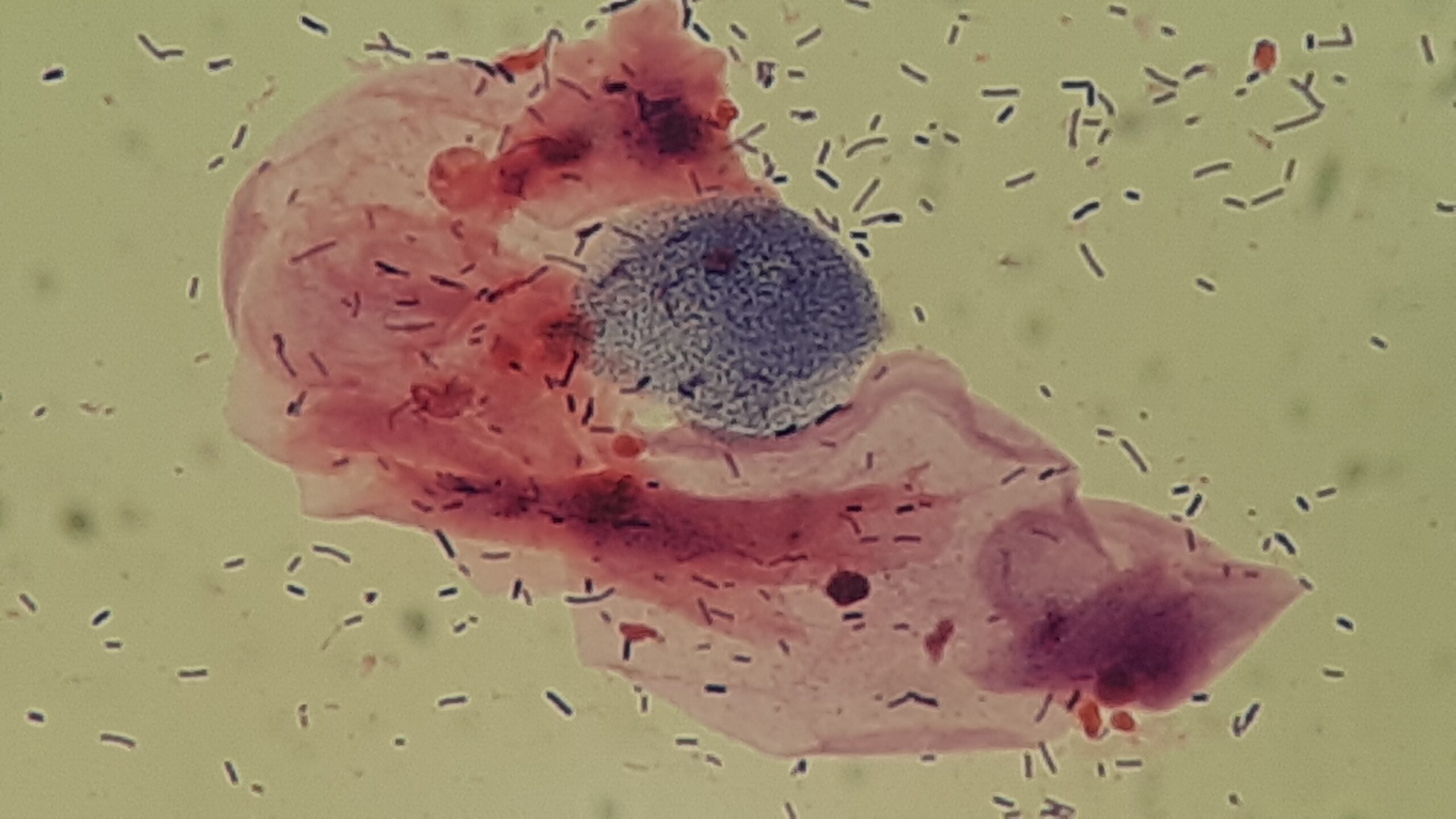 Vaginal Cell and Bacterial Interaction in Gram staining of HVS