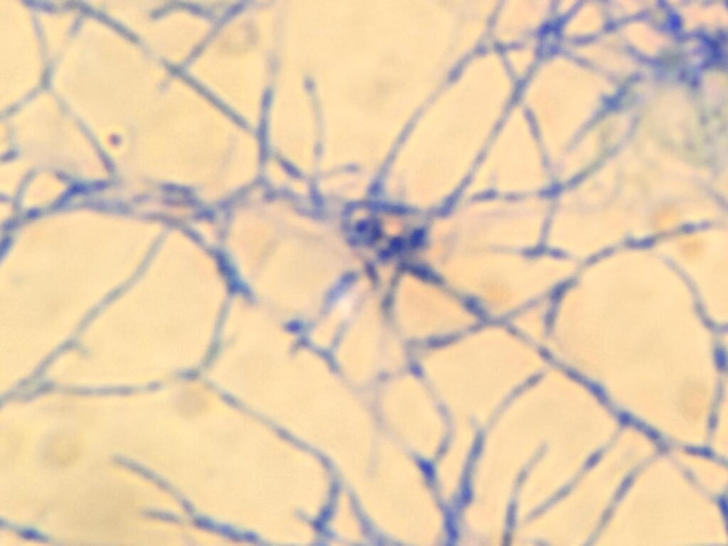 Nocardia in Ziehl-Neelsesn staining at a magnification of 1000X with 8x optical zoom