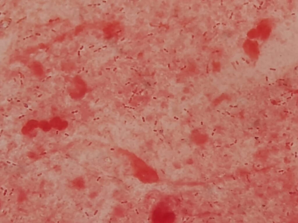 Acinetobacter baumannii in Gram staining of sputum