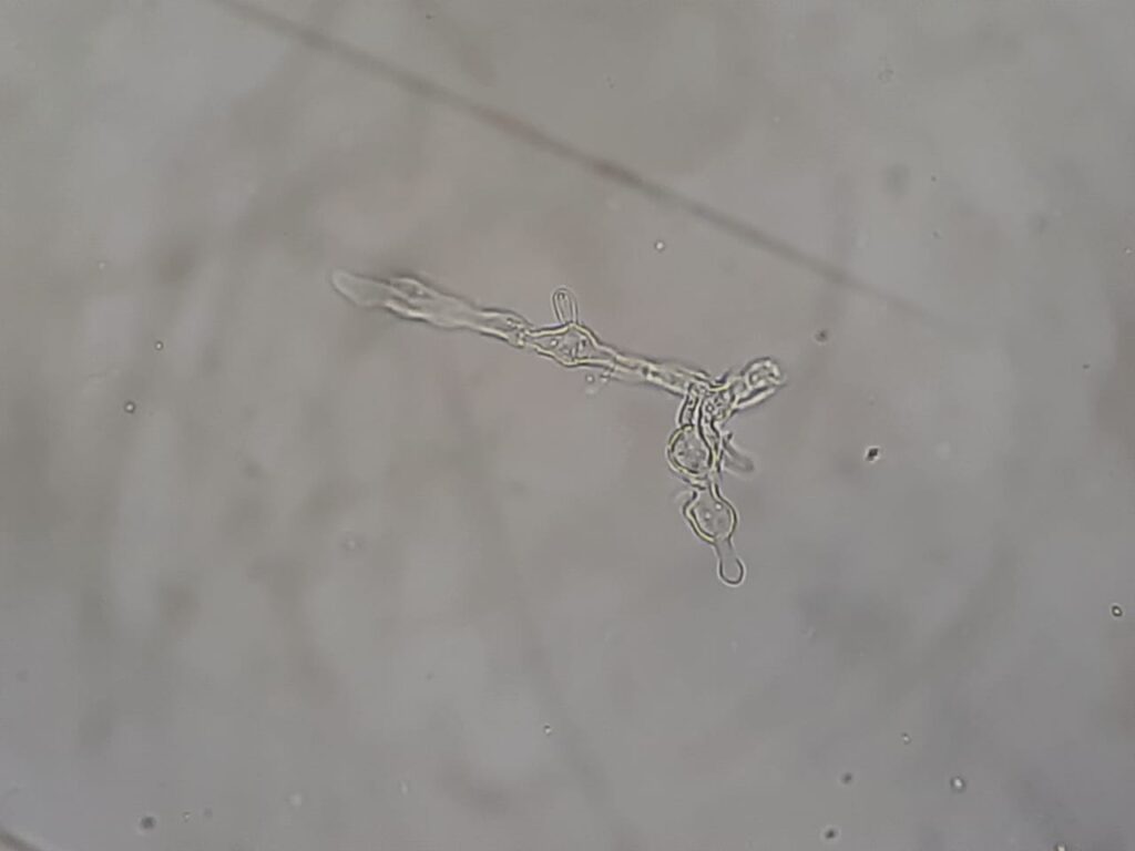 Fungal element found in KOH mount of BAL from an immunoocomprimized host