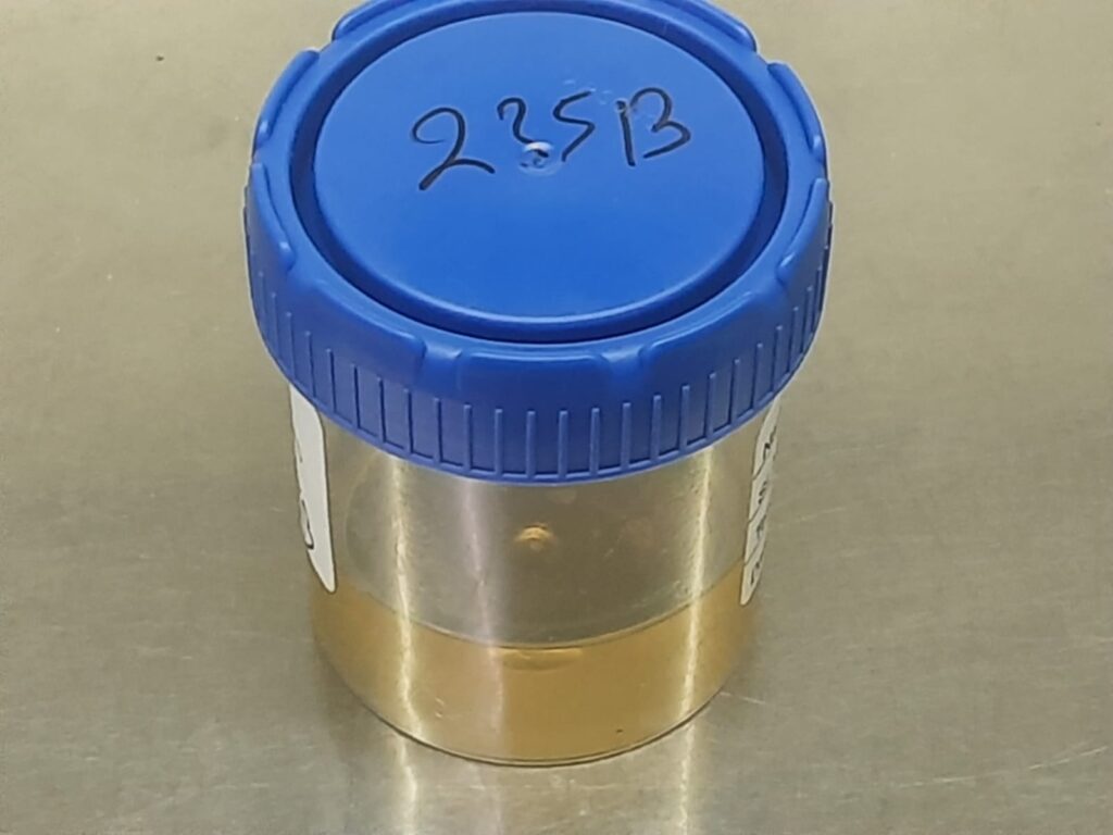 Urine sample of a patient for fungal culture and KOH mount assay