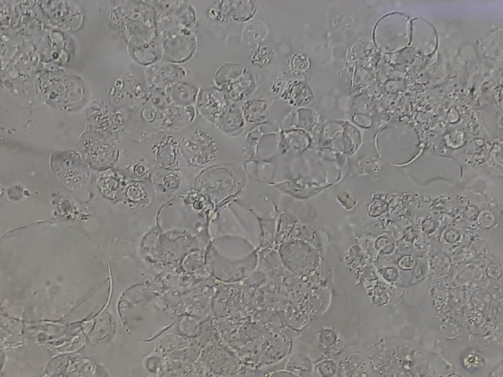 Photomicrograph of fat globules and cells in perotionieal fluid at a magnification of 1600X
