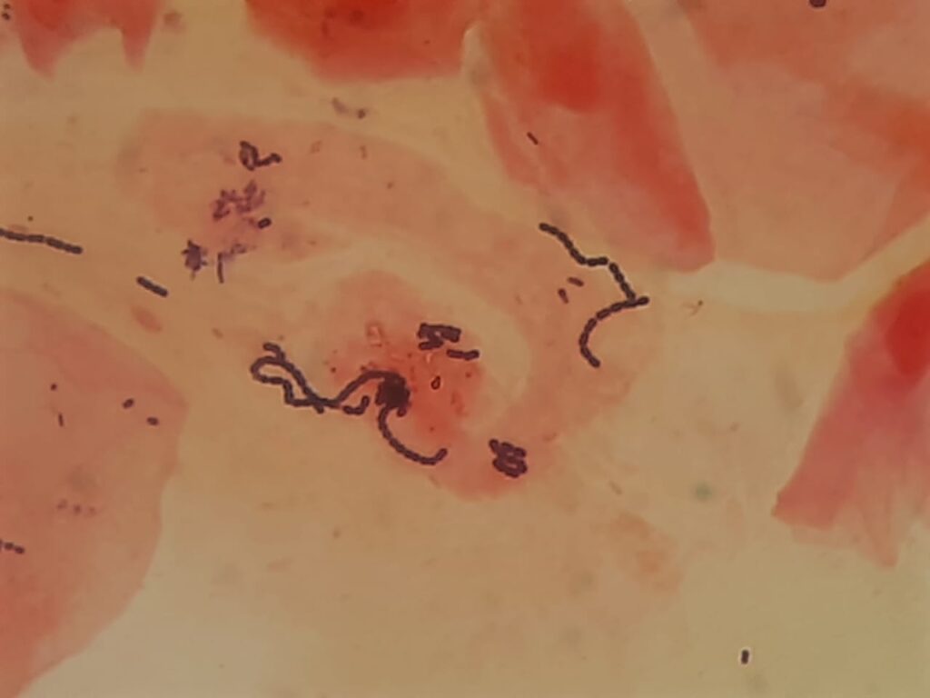 Gram positive cocci in singles, pairs, and long chains in throat swab Gram staining