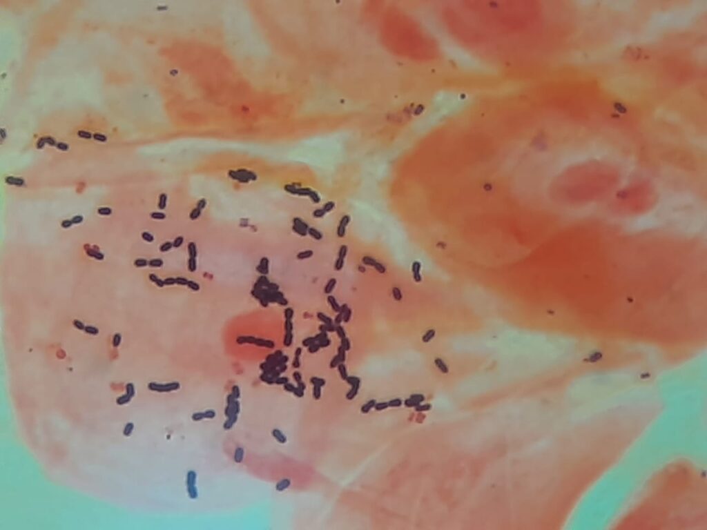 Gram positive diplococci, Gram negative coccobacilli, and epithelial cells in throat swab Gram stain microscopy at a magnification of 4000X