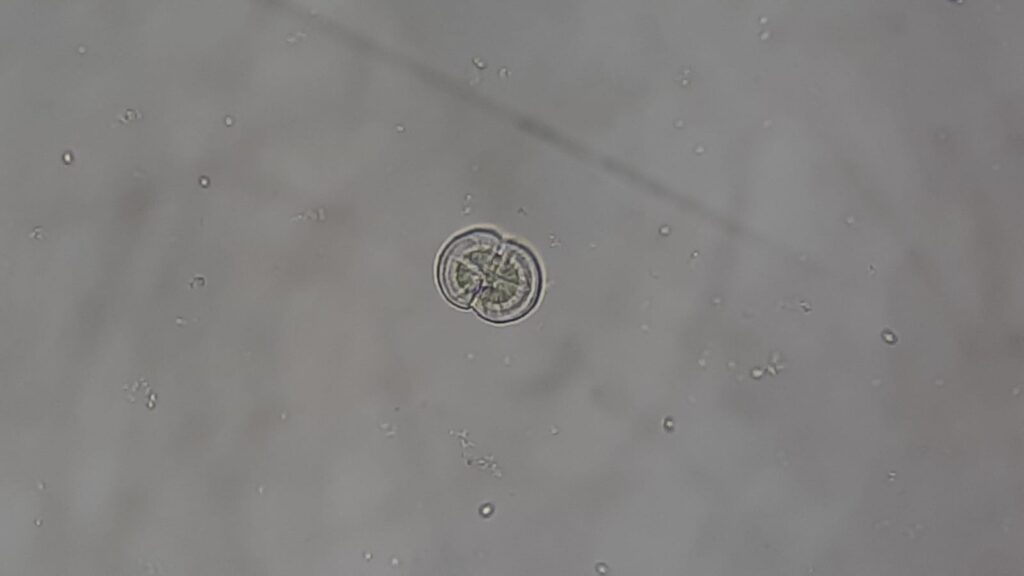 Leucine crystal in KOH mount urinary sediment microscopy at a magnification of 1600X